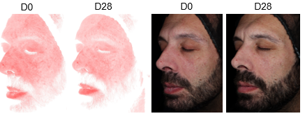 Clinical redness reduction with Resiskin on male subject