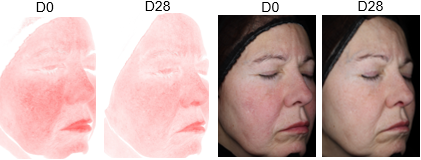 Clinical redness reduction with Resiskin on female subject
