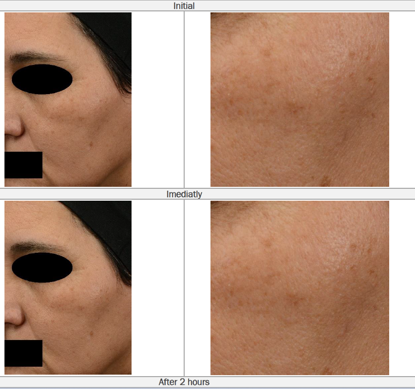Clinical glow improvement with Linodermine