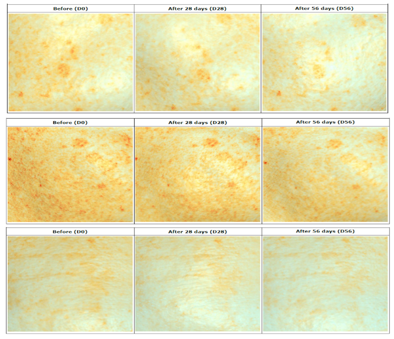 Clinical dark spot reduction and skin tone improvement with Lumidermine