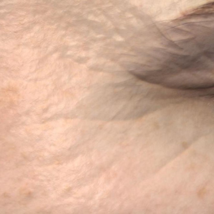 Skin before treatment, day 0
