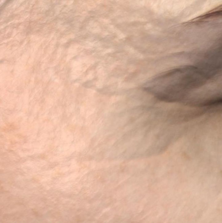 Linodermine clinical result after 56 days