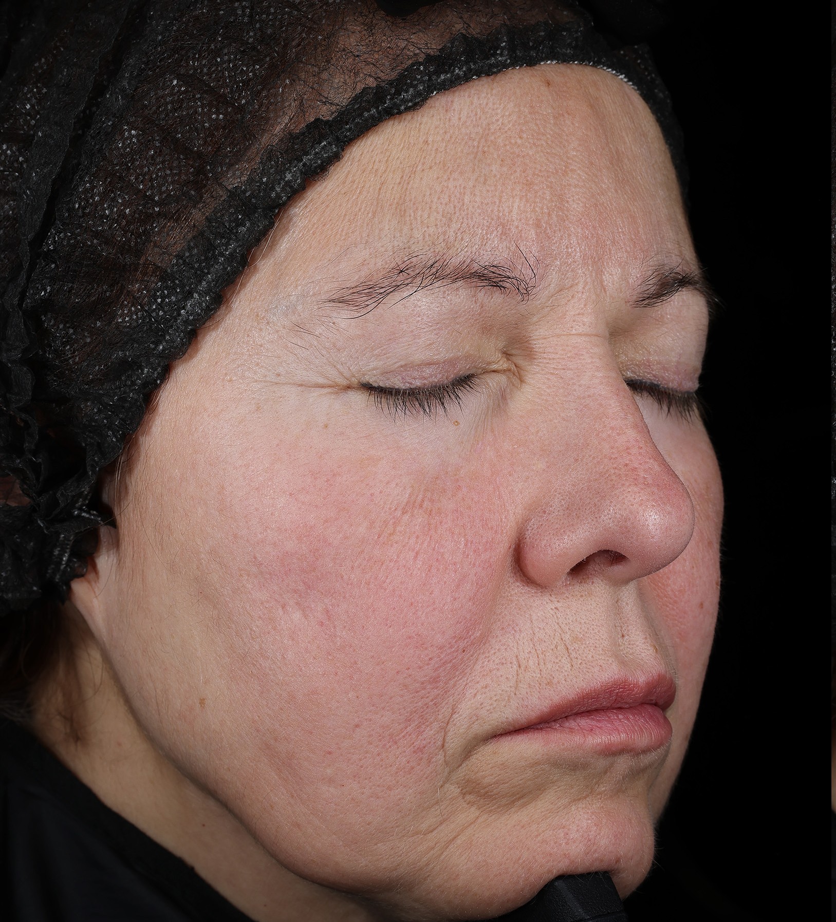 Skin before treatment, day 0