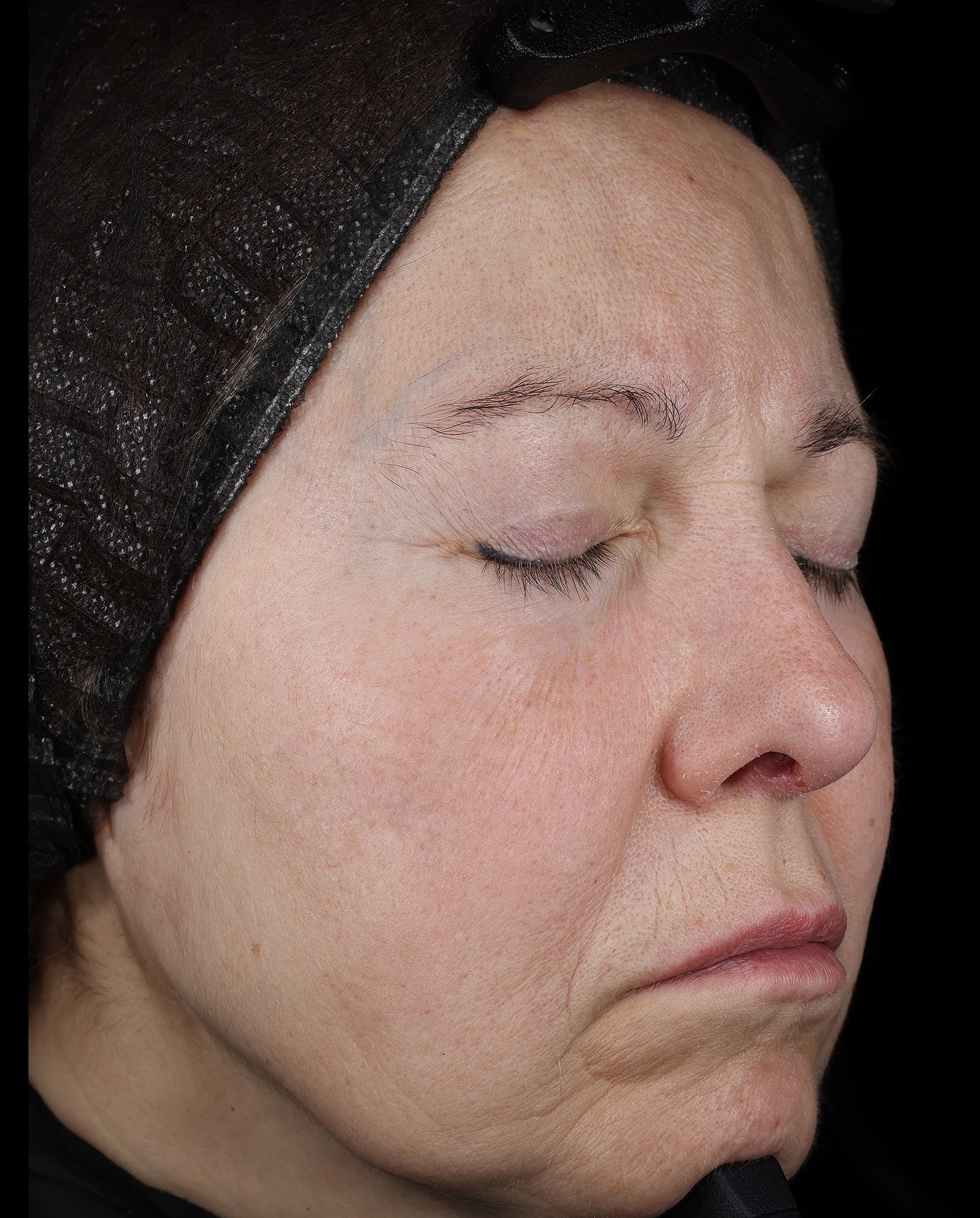 Resiskin clinical result after 28 days